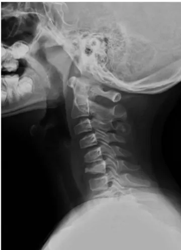 Fig. 2. MRI scan shows marked compression and anterior wedging of C6 spine with minimal spinal canal narrowing