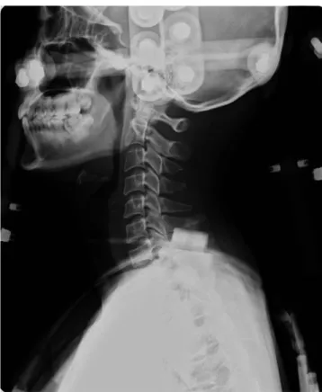Fig. 7. 12 weeks after injury: Dynamic view of cervical column showed acceptable stabilization and union of Hangman’s fracture.