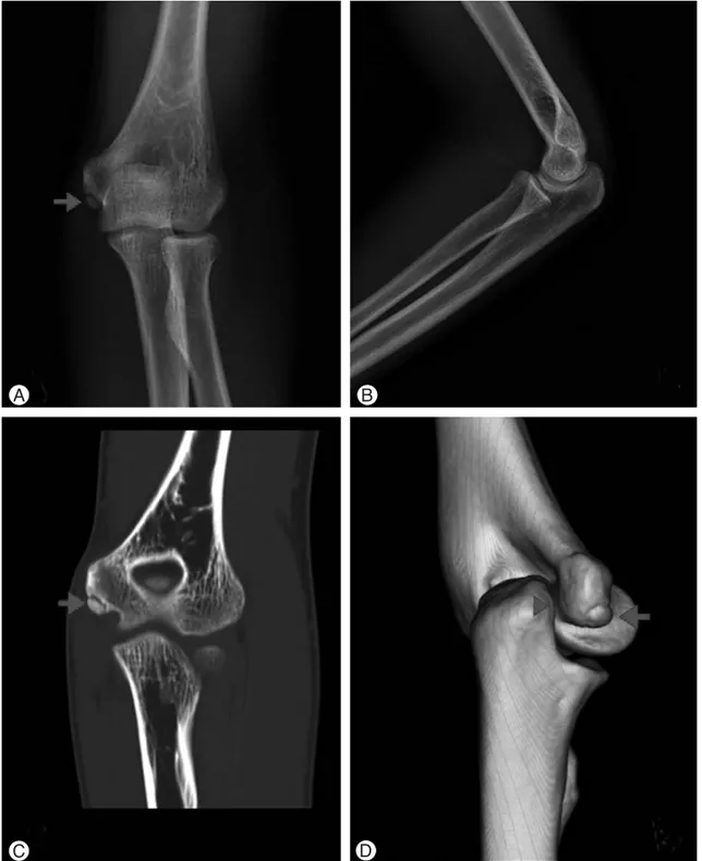 Fig. 1. Anteroposterior and lateral radiographs (A, B) and CT scans (C, D) of a 16-year-old male with ulnar nerve palsy