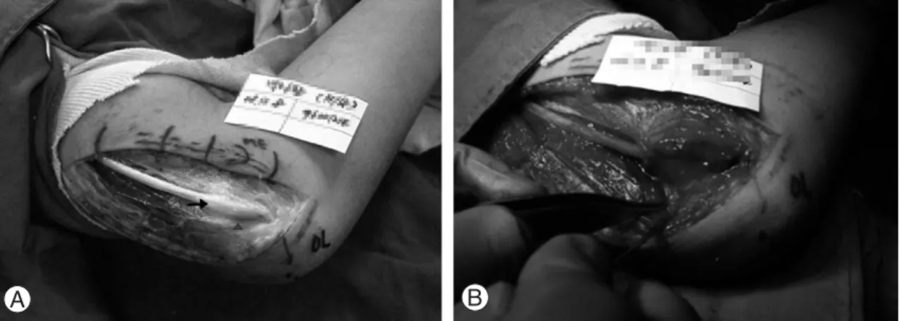 Fig. 2. Intra-operative photograph shows dislocation of the hypertrophied ulnar nerve (arrow) above the medial epi- epi-condyle (arrow head)