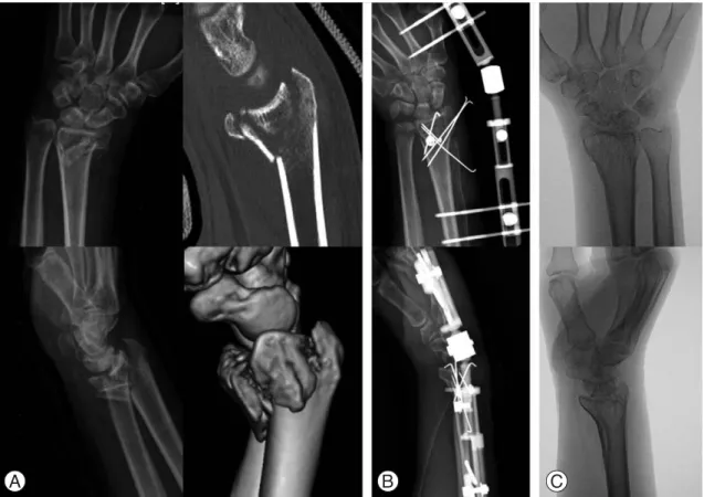 Fig. 1. A 57-year-old man with unstable distal radius fracture was treated by open reduction and internal fixation using K-wires supplemented with a external fixator