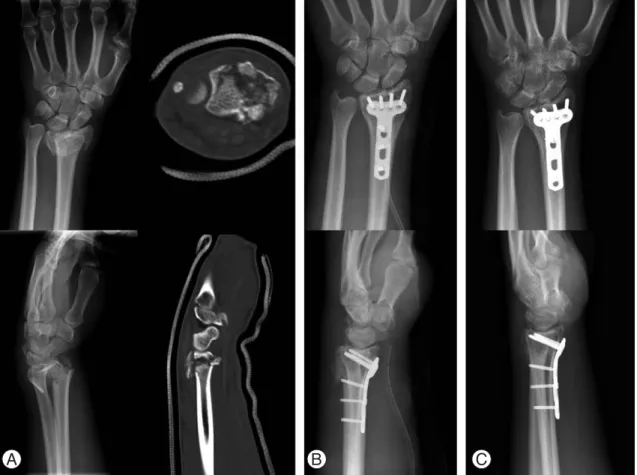 Fig. 2. A 21-year-old man with unstable distal radius fracture was treated by open reduction and internal fixation with volar locked plate