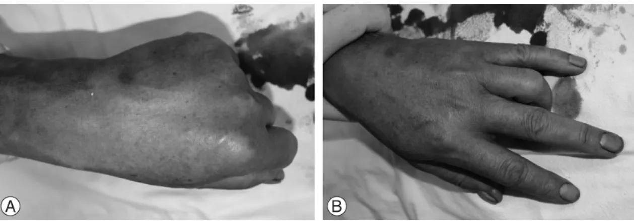 Fig. 2. Preoperative X-ray showing no specific lesions affecting the extensor tendons on the wrist.