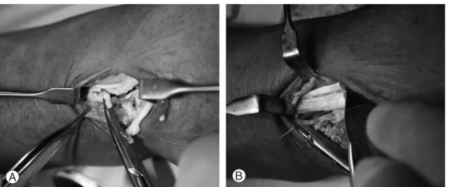 Fig. 3. Intraoperative views. (A) Complete rupture of extensor digitorum tendons of the ring and little finger and par- par-tial rupture of extensor digitorum tendon of the middle finger at the wrist level