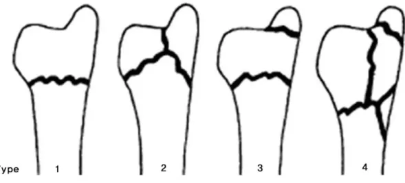 Fig. 1. Biyani classification 1 of distal ulnar fractures. Type 1, simple extra-articular fracture with minimal comminution