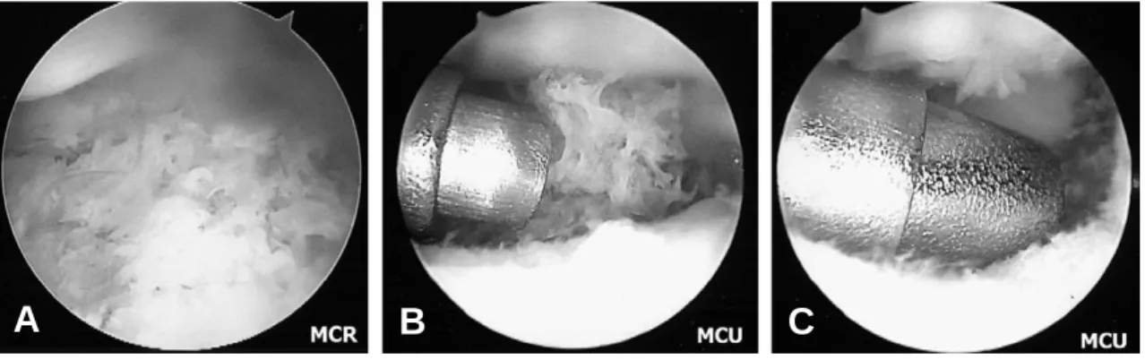 Fig. 5. Immediate postoperative plain left wrist AP (A) and lateral (B) radiographs show internal fixation with K- K-wires and corrected dorsal intercalated segmental instability deformity.