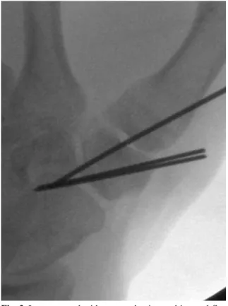 Fig. 4. Twelve months postoperative radiographs showed no evidence of post-traumatic arthritic changes at CMCJ of the thumb