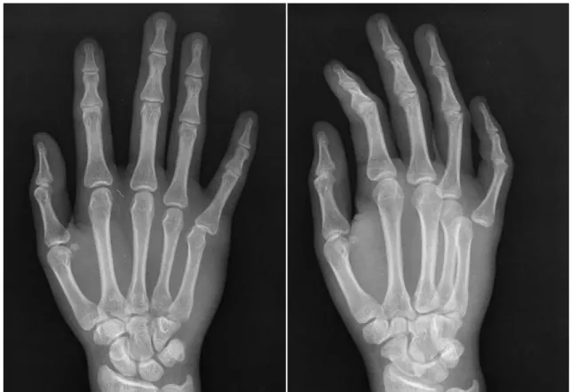 Fig. 1. Radiographs showing the dislocation of the 5 th metacarpophalangeal joint.