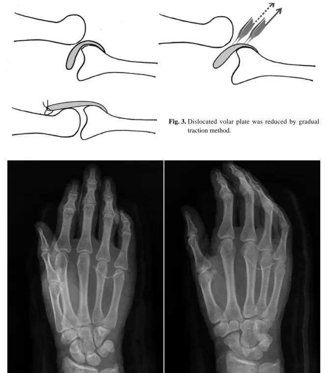 Fig. 3. Dislocated volar plate was reduced by gradual traction method. 