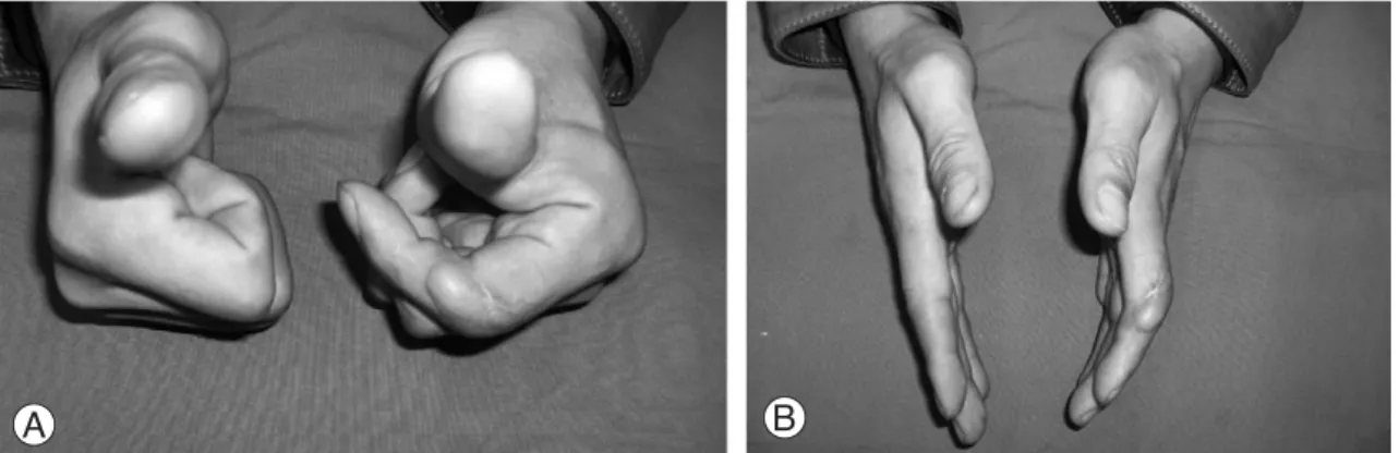Fig. 7. Limited active motion is shown at 1 year follow-up. (A) flexion, (B) extension.