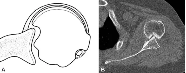 Fig. 1. (A) A small amount of external rotation can cause the Hill-Sachs lesion to engage the anterior glenoid