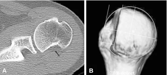 Fig. 4. (A) Axial view of computerized tomographic scan shows the large size of the defect