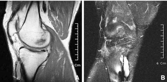 Fig. 2. MRI shows expansion of the tibial tunnel. (A) T1-weighted Sagittal image shows low signal intensity of the cyst distal to the tibial tunnel