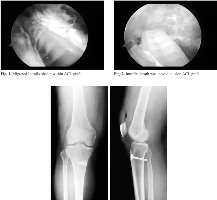 Fig. 3. Postoperative AP and lateral radiographs. Note the additional fixation of the graft using spike washer and screw.
