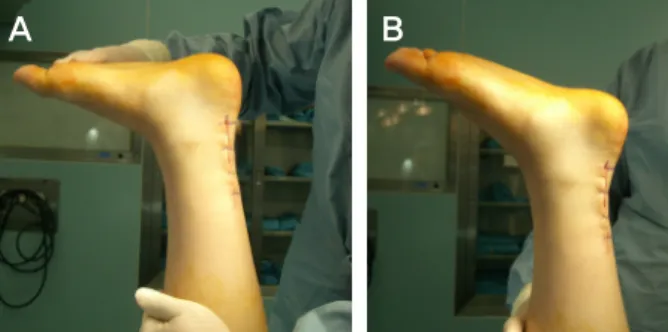 Figure 2. (A) Intraoperative finding: massive defect is shown about  12 cm after debridement of scar and degenerative tissue