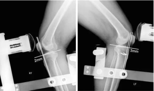 Fig. 3. Postoperative stress view shows 1.0 mm side-to-side difference with anterior drawer.
