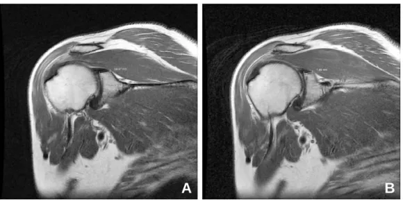 Fig. 1. Measurement of the attachment of the superior glenoid labrum on coronal MRI are shown at anterior spot (A) and posterior spot (B).