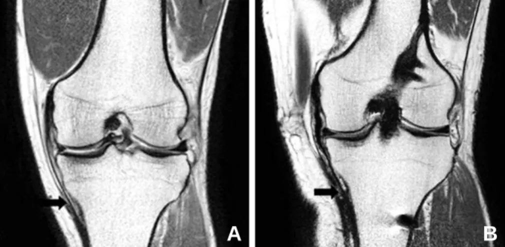 Fig. 2. Coronal MRIs demonstrated distal insertion of hamstring tendons. More proximal insertion of harvest hamstring tendon (B) than on the non-operated side (A).