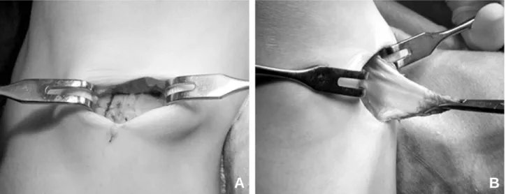 Fig. 5. Our modified technique for harvest hamstring. Reversed L-shaped incision to the sartorius fascia was made (A)