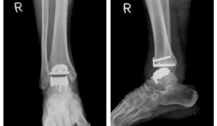 Figure 5. Postoperative plain radiographs shows total ankle re- re-placement state and no evidence of further destructive changes or  cysts