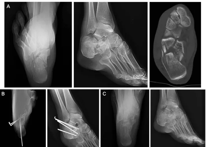 Figure 5. After opened reduction of displaced subtalar joint, K-wire 