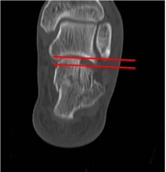 Figure 1. Preoperative CT semi-coronal image showing the radio- radio-logical assessment of the joint depression.