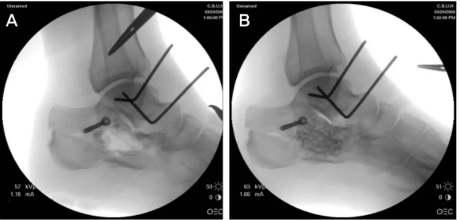 Figure 4. (A-B) Intraoperative fluoroscopes show  the size of bone defect and proper placement of  bone graft substitute in calcaneus.