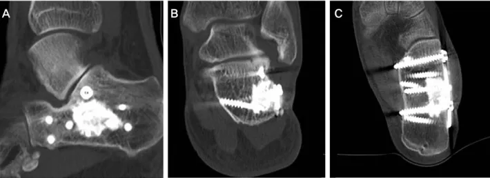 Figure 5. (A-C) CT images at postoperatively 6 months show the maintenance of height of subtalar joint and the resorption of bone graft  substitute