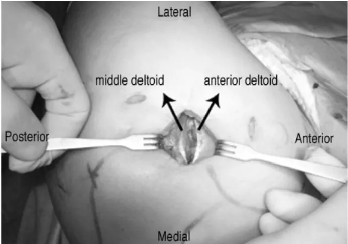 Fig. 2. A deltoid retractor was then placed, allowing direct visualization of the rotator cuff and humeral head.