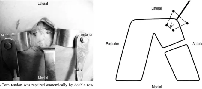 Fig. 3. Torn tendon was repaired anatomically by double row technique using suture anchors.