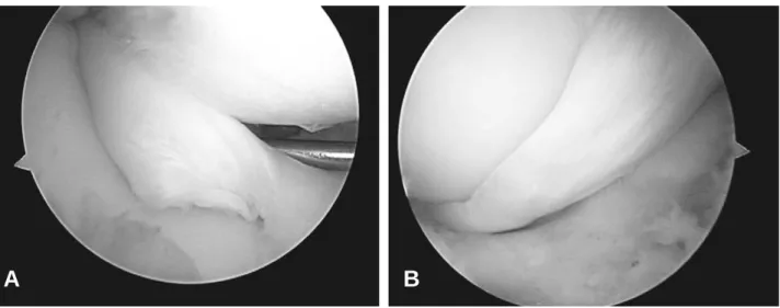 Fig. 3. (A) Probing induced displaced medial meniscus bucket handle tear during diagnostic arthroscopy