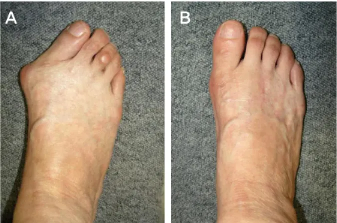 Figure 3. Photograph show (A) preoperative severe hallux valgus  deformity. (B) good alignment at postoperative 12 months follow-up