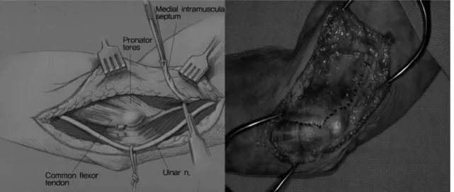 Fig. 2. Medial “over the top” approach.