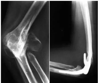 Fig. 3. Distraction Arthroplasty. Fig. 4. Total elbow replacement arthroplasty.