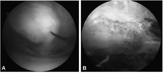 Fig. 3. (A) Arthroscopic finding shows coracoids impingement with bony spur. (B) Arthroscopic coracoplasty was done