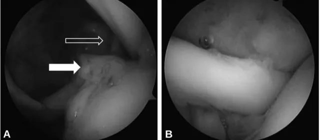 Fig. 6. Postoperative follow up sagittal view of CT arthr- arthr-ography shows the intact rotator interval.