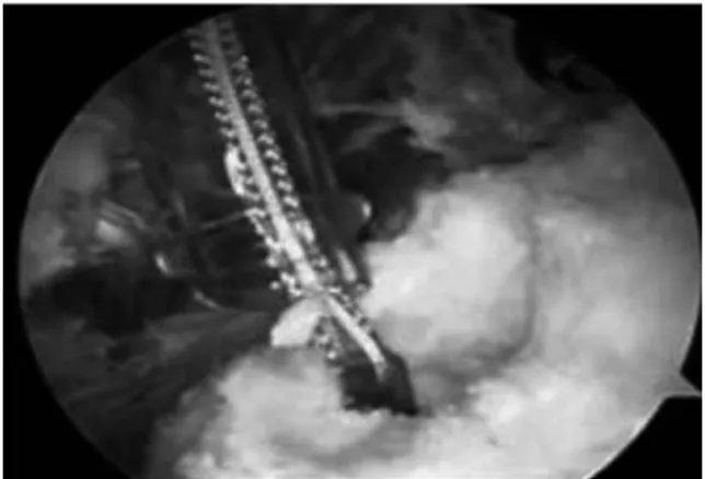 Fig. 2. This picture shows pullout of anchor in osteoporot- osteoporot-ic bone.