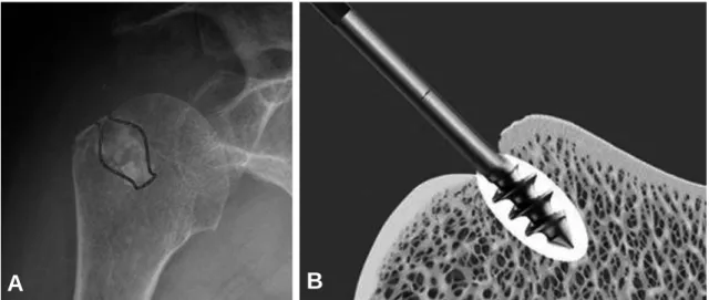 Fig. 5. (A) The bone cement is pressurized to gel a cement mantle of the shape of a pot