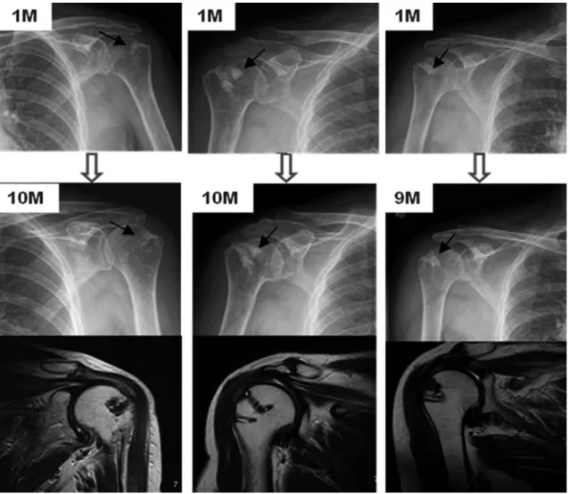 Table 2. Sugaya classification of the rotator cuff status after repair of the rotator cuff by magnetic resonance imaging 