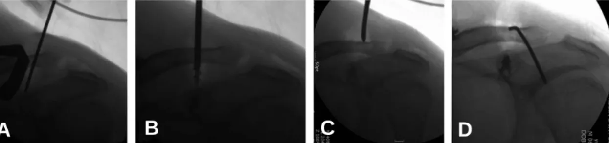 Fig. 1. (A) The coracoids process can be identified using the K-wire. (B) Two suture anchors are fixed at the original site of conoid and trapezoid ligament