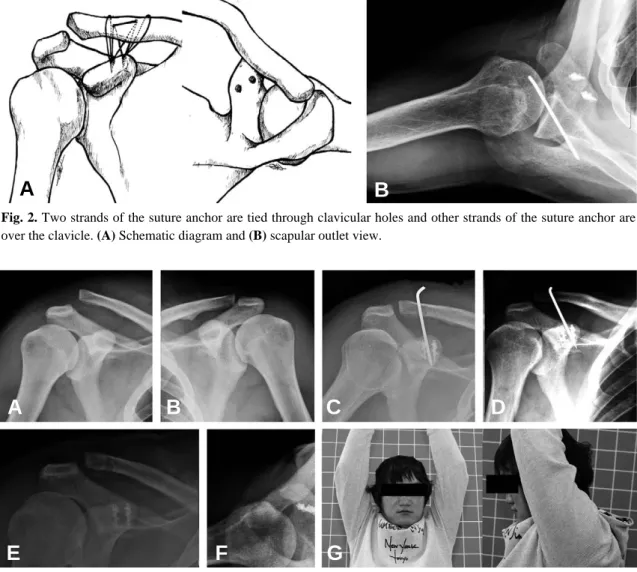 Fig. 2. Two strands of the suture anchor are tied through clavicular holes and other strands of the suture anchor are over the clavicle