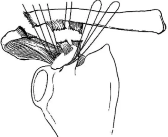 Fig. 2. After transarticular fixation of more than two K-wires, four strands of Ethibond were tied  for augmentation.