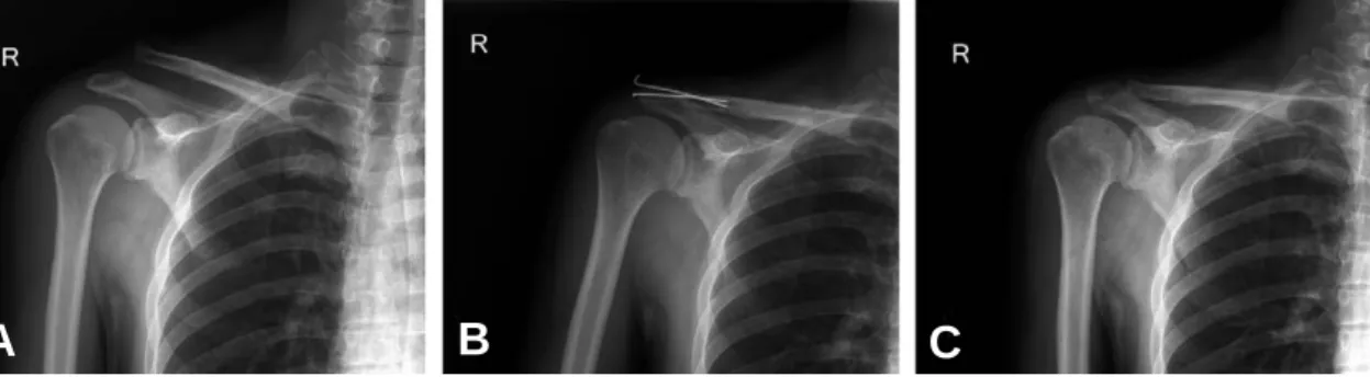 Table 2. Reduction of coracoclavicular distance