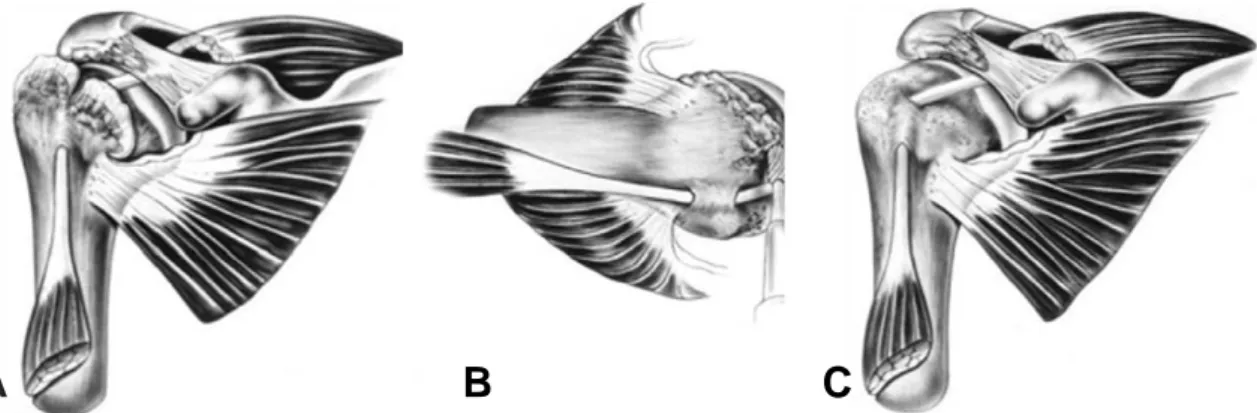 Fig. 2.  결절성형술 . (A) 상완골 대 결절에 반응성으로 생긴 외골증 (exostoses). (B) 연마기 (burr) 를 이용하여 돌출된 뼈을 제거하며 결절면을 부드럽게 다듬는 결절성형술의 모습 