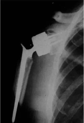 Fig. 2. Semiconstrained Dana shoulder prosthesis.