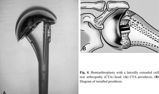 Fig. 4. Hemiarthroplasty with a laterally extended cuff tear arthropathy (CTA) head. (A) CTA prosthesis, (B) Diagram of installed prosthesis.