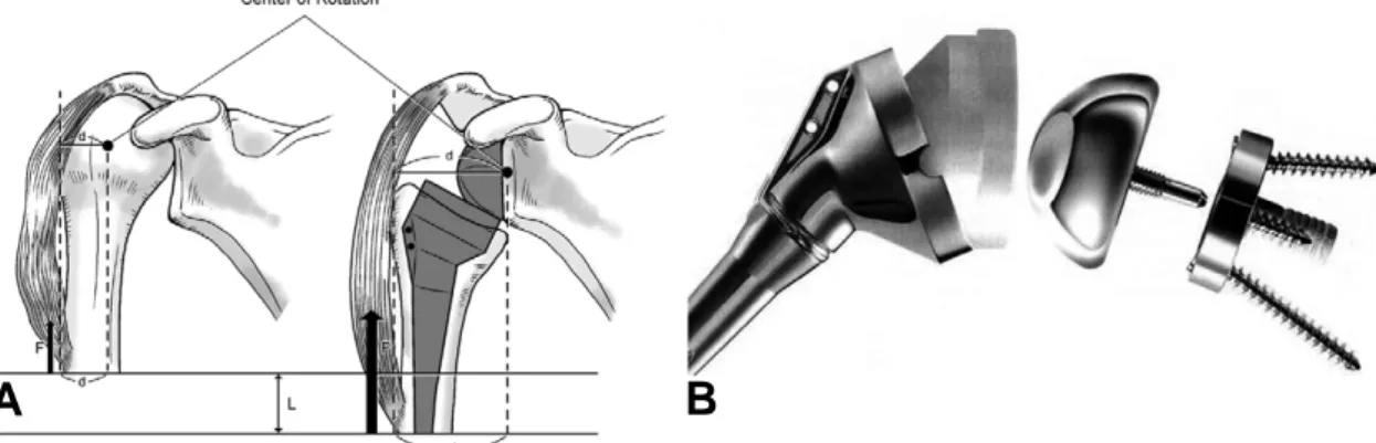 Fig. 5. (A) A reverse total shoulder prosthesis. (B) Reversing the ball and socket changes the mechanics of the shoul- shoul-der joint in orshoul-der to improve active range of motion and deltoid muscle strength
