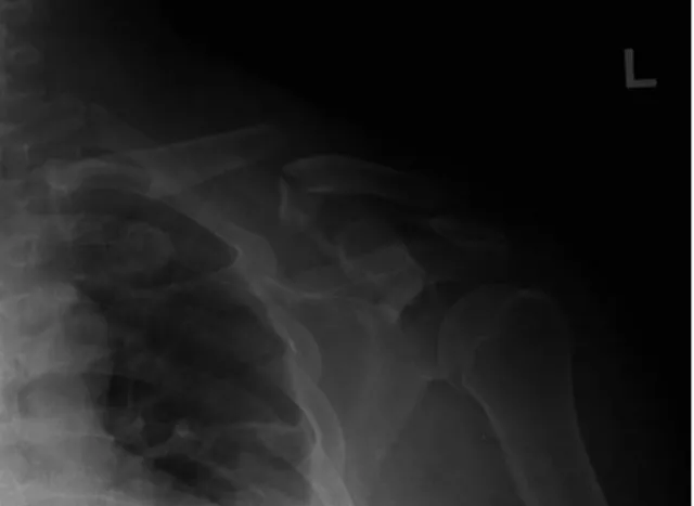 Fig. 2. (A-C) 3D Computed tomography shows floating shoulder with displaced transverse glenoid fracture.