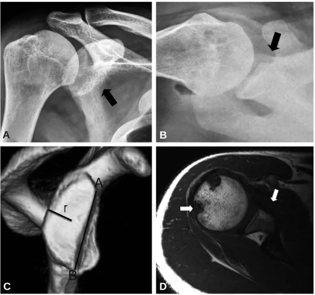 Fig. 1. A 25-year-old man who has recurrent anterior dislocation of the shoulder. (A, B) Simple x-rays show signifi- signifi-cant bony loss of the anterior glenoid