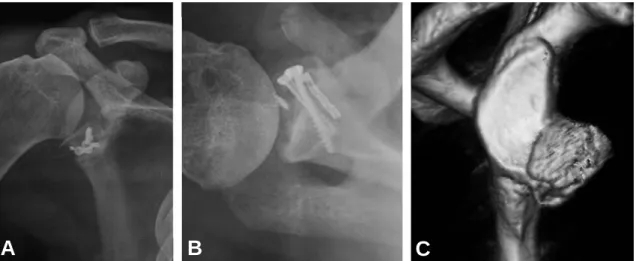 Fig. 3. Postoperative X-ray demonstrates autogenous bone graft is fixed with AO 4.0 mm cannulated screws